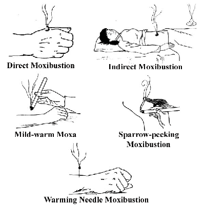 Moxibustion - Chinese Medical Centre of Cyprus